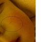 Atrophic Facial Scar from fingernail  - 3 year old