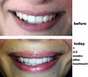 Before & 2.5 weeks after