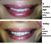 5 days after & 2.5 weeks after