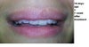 focus on bumps 7 days after