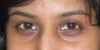Under-eye wrinkles, hollowness, and dark circles