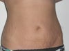 up close, front abs, scarring