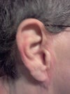 Right Ear
