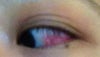 Left eye