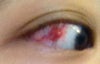 Right eye