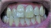 biting on back teeth