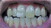 biting on front teeth