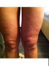 Bumpy skin around knees