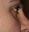 under eye hollowness