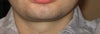neck laxity and fat
