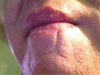 Scar lower lip to center chin