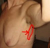 flap/skin circled