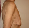 Side view breast