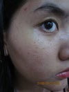 Brown bumps and open pore. Extremely oily skin