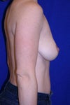 another before the first implants