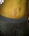 Scar on my stomach after 2 revision surgeries, many cortisone injections and pretty much every procedure out there to improve looks of keloids.
