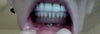 After last visit added some ugly hard clear layer to bottom gums.