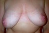 Stretch marks
