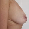 Larger right breast