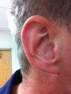 Unoperated right ear, left ear had same size conchal bowl.
