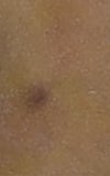 flat facial mole