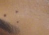 flat facial mole