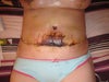 2 weeks after surgery
