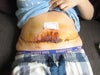 1 week after surgery