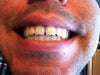 Moderate open bite of front teeth