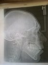 Lateral Ceph of open bite