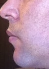Profile view: top lip sticks out too much