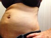 I had my abdomen and flanks done. Can see major lumps, tires (under bra line) and unevenness all over belly (wore garment for 6 weeks!) Can also see areas where he was too aggressive (under belly button and on flanks). Scars never disappeared after 2 years.