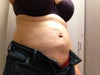 I had my abdomen and flanks done. Can see major lumps, tires (under bra line) and unevenness all over belly (wore garment for 6 weeks!) Can also see areas where he was too aggressive (under belly button and on flanks). Scars never disappeared after 2 years