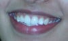 Full smile. Since this picture was taken, I have gotten laser gum contouring done, so the degree of my gummy smile has reduced.