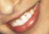 No upper lip and this isnt even my "I won the lottery smile"