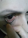 "Fleshy strip" on bottom of right eyeball.