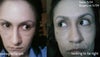 Restricted eye movement.