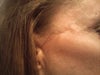 face lift scar