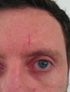 Atrophic Forehead Scar
