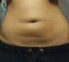 after lipo, and the bulge under the belly button and the line under is bothering me.