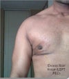 left chest