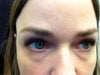 Under eye treatment