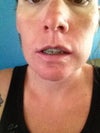 Me 4 weeks after surgery.