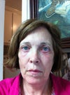 droopy lower left eye May 29, 2012
