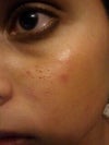 Just one side of my face, the right side. Ice pick scars all over. These have been there since 2005. Since then, my acne has not been very severe.
