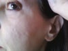 Cheek with dent & scars