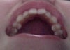 This is of my upper teeth (jaw?), kind of an awkward photo...