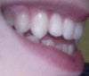 Right side of my mouth