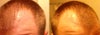 Scaring in both temples from hair transplant