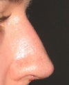 Taken about a week after rhinoplasty.